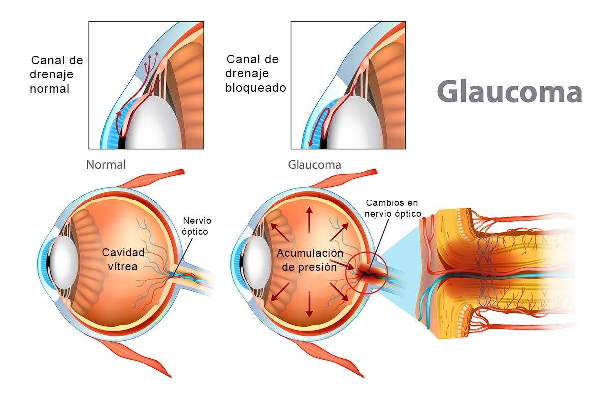 Glaucoma infografia