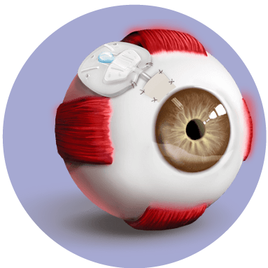 Implante de dispositivos de drenaje para glaucoma cirugía de glaucoma en guayaquil