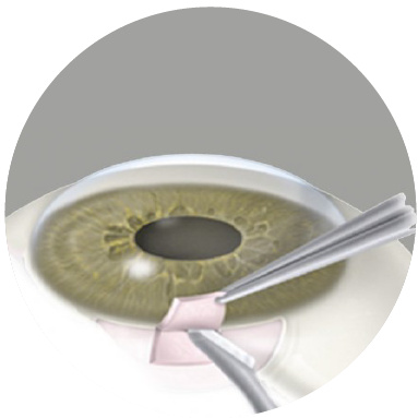 Trabeculectomía en guayaquil cirugia de glaucoma en guayaquil