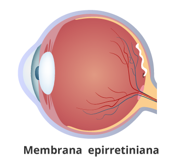 Membrana--epirretiniana en guayaquil Retinólogo en guayaquil
