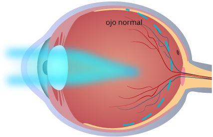 ojo-miopia