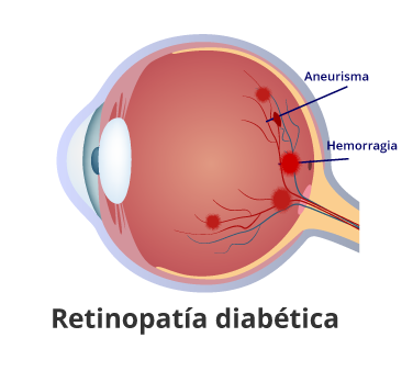 retinopatía diabética en guayaquil