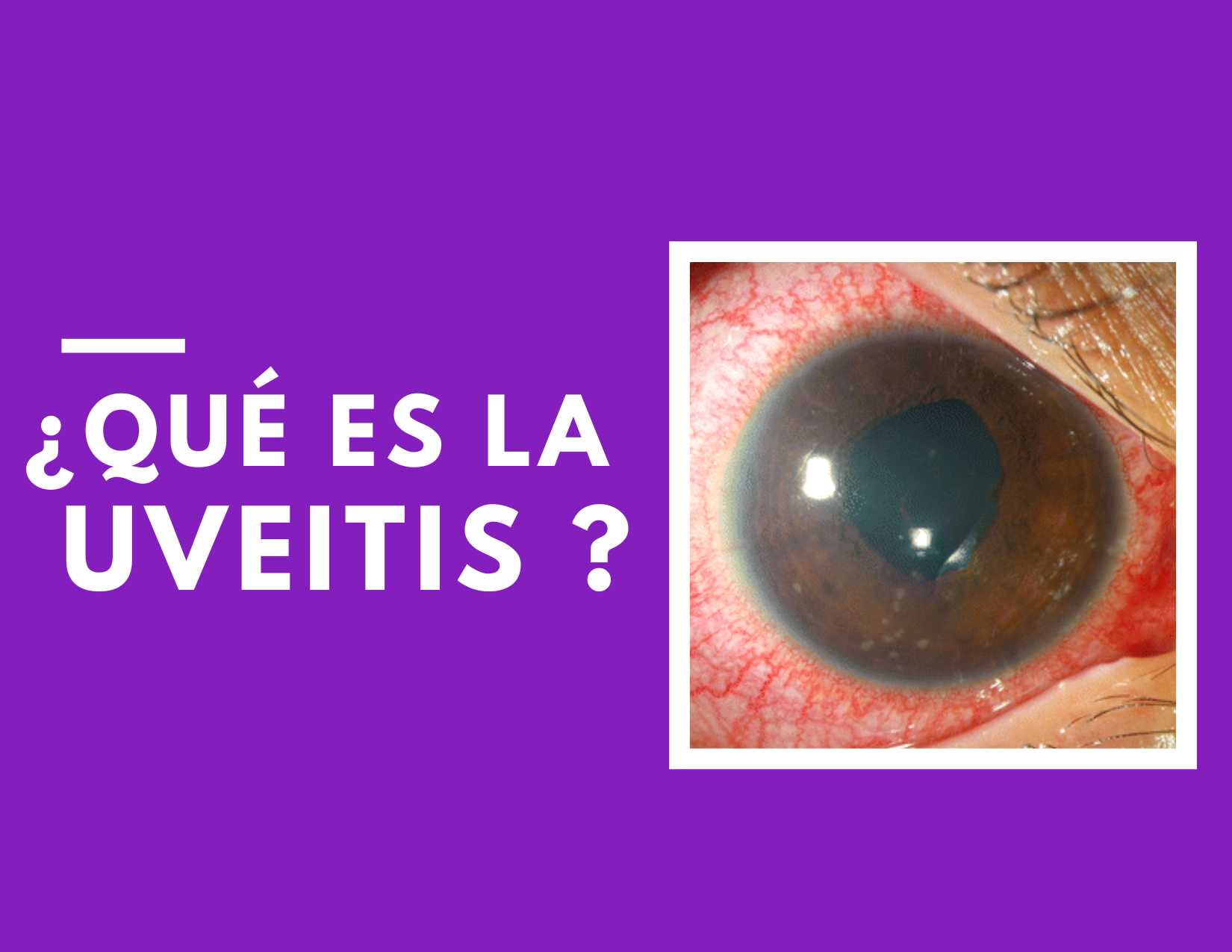 uveitis guayaquil qué es uveitis guayaquil
