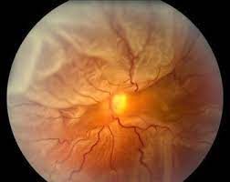 desprendimiento retiniano desprendimiento de retina guayaquil