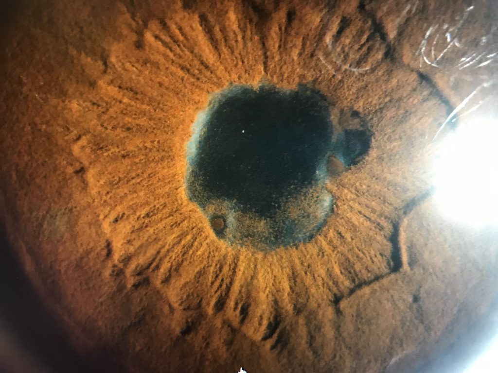 glaucoma secundario Uveitis Uveitis secundaria a HLA b27 uveitis