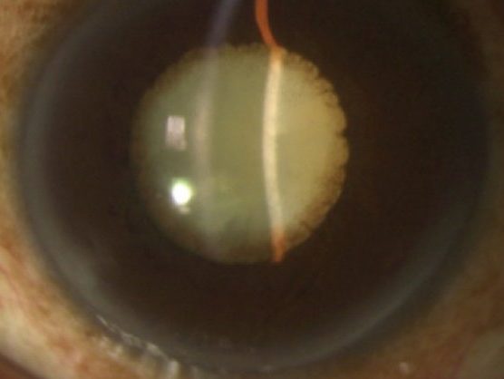 Catarata secundaria a Uveitis