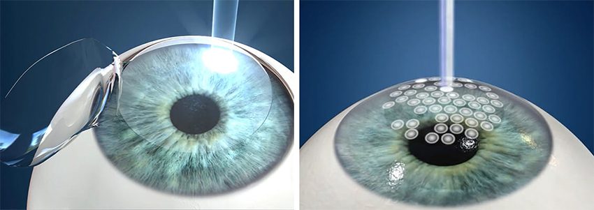 cirugía de miopia astigmatismo Guayaquil