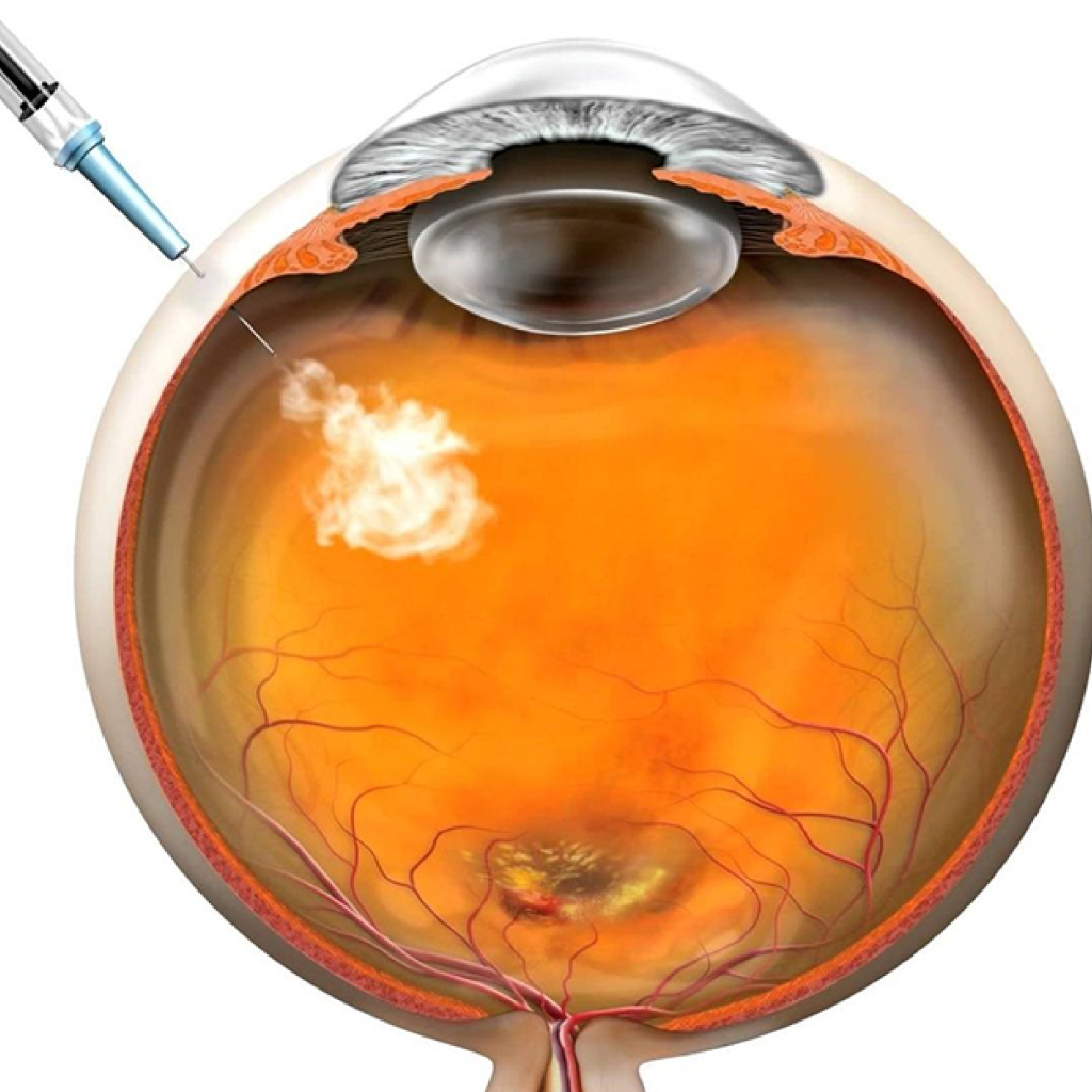Procedimiento-Inyeccion-intravitrea-retinologo-guayaquil-ecuador injecciones intravítreas guayaquil