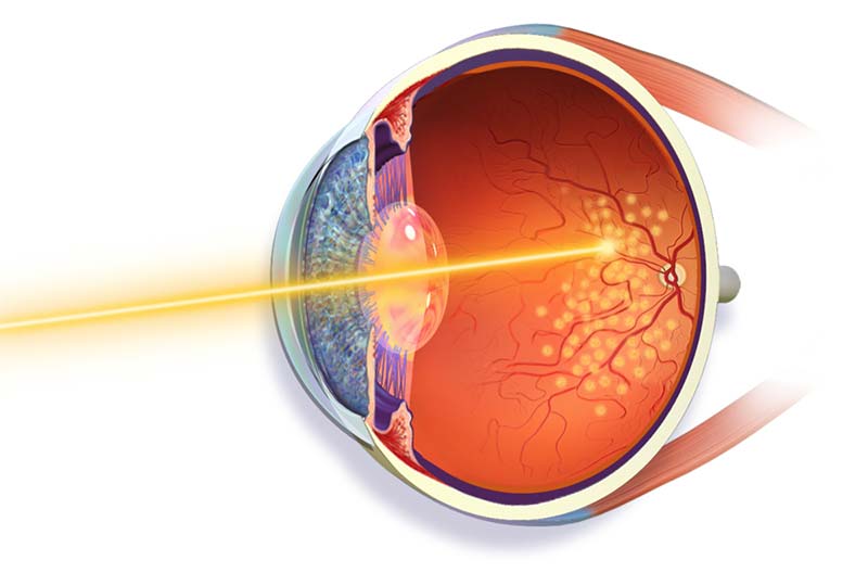 laser retina -retinólogo Guayaquil laser retina Guayaquil