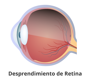 Desprendimiento-de-retina en Guayaquil Retinólogo en guayaquil