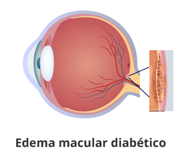 Edema-macular-diabético Retinólogo en guayaquil