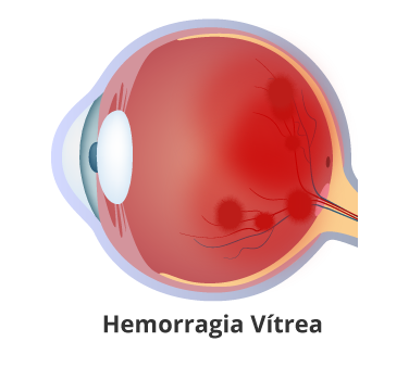 Hemorragia-Vítrea en guayaquil Retinólogo en Guayaquil