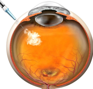 Procedimiento-Inyeccion-intravitrea-retinologo-guayaquil-ecuador injecciones intravítreas guayaquil