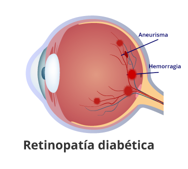 Retinopatía-diabética en guayaquil retinopatía diabética en guayaquil