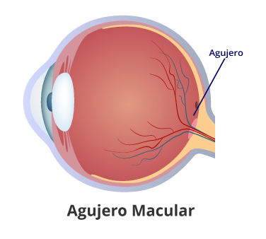 agujero-macular Retinólogo en guayaquil