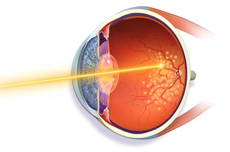 laser retina -retinólogo Guayaquil laser retina Guayaquil
