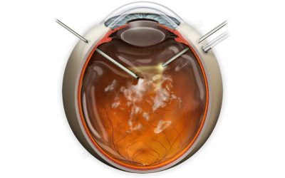 vitrectomía guayaquil-Retinólogo Ecuador Cirugía de retina guayaquil