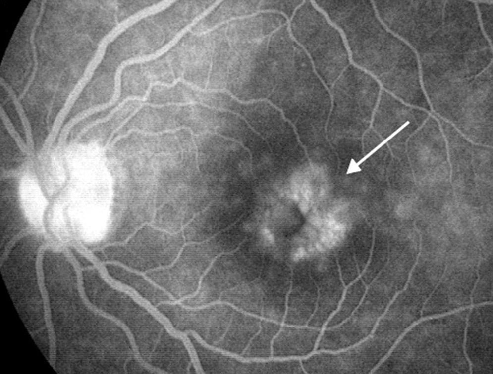 edema macular Oftalmologos Guayaquil Ecuador